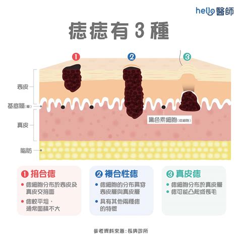 臉 長痣|痣形成的原因？痣長毛、痣變多變大是痣病變？5招判。